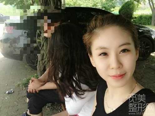 面部自体脂肪填充手术2个月后记