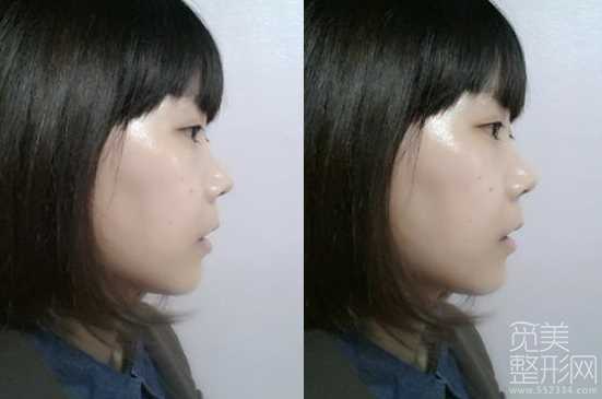 两鄂和颧骨整形手术1个月后记