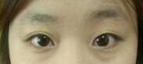 觅美网专业整形咨询预约网【点击右方咨询窗口进行咨询】 韩式三点双眼皮+硅胶隆鼻2个月后