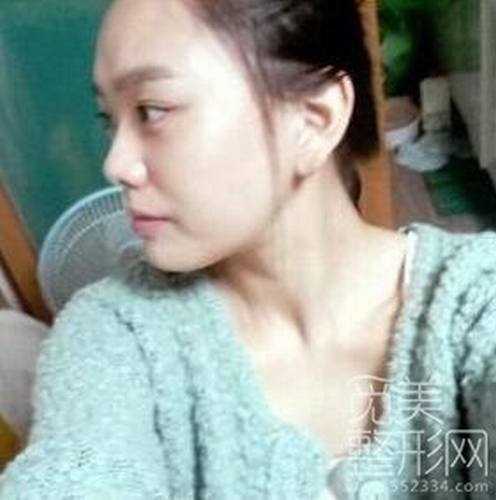 隆鼻吧 隆鼻 隆鼻案例图【点击右方咨询窗口在线*】 隆鼻吧 硅胶隆鼻 隆鼻手术6个月案例图