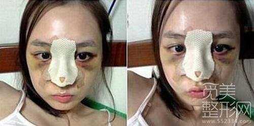 隆鼻吧 隆鼻 隆鼻案例图【点击右方咨询窗口在线*】 隆鼻吧 硅胶隆鼻 隆鼻手术6个月案例图