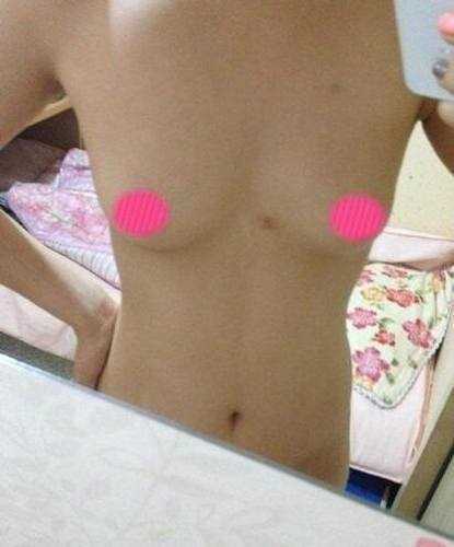 【点击右边咨询窗口与*在线交流】 假体隆胸整形手术1个月后