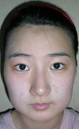 【点击右方咨询窗口与专业整形*交流】 下颌角削骨 面部填充 玻尿酸隆鼻术后案例图