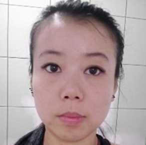 【点击右方咨询窗口24小时专家在线解答】 下颌角削骨 隆鼻手术获得年轻容颜