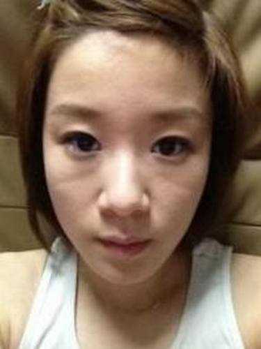 【点击右方咨询窗口与专业整形*在线交流】 脸部自体脂肪填充8个月后