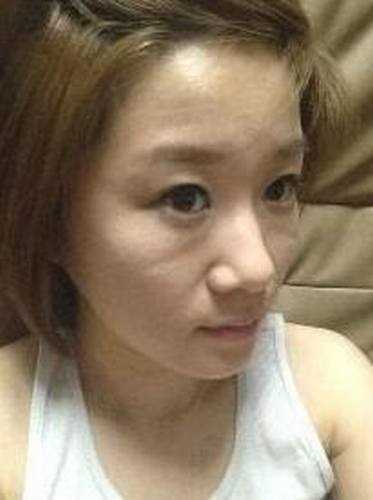 【点击右方咨询窗口与专业整形*在线交流】 脸部自体脂肪填充8个月后