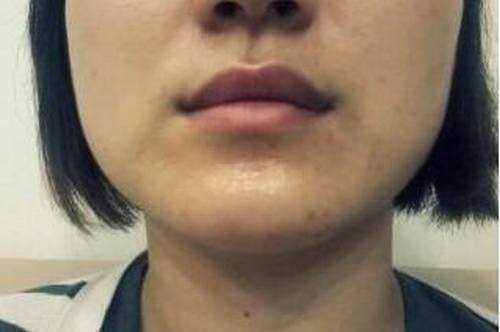 【点击右方咨询窗口与专业*在线交流】 打*术后3个月