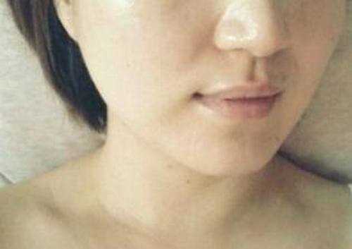 【点击右方咨询窗口与专业*在线交流】 打*术后3个月
