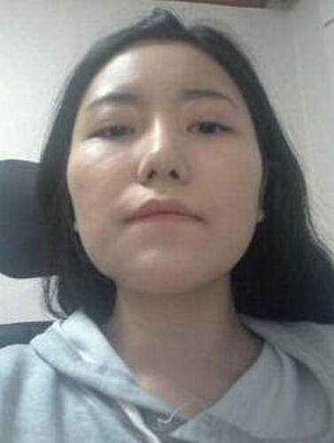 点击右方咨询窗口与觅美网*在线咨询 颧骨降低+下巴矫正手术32天后