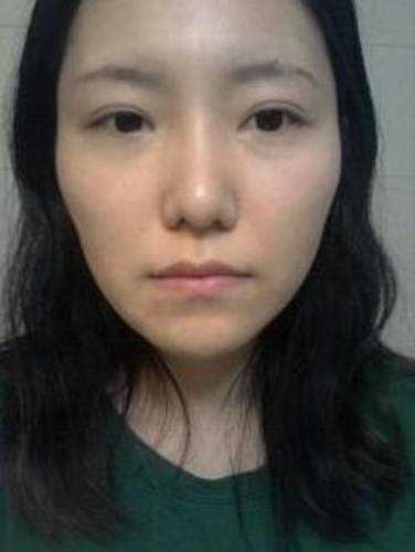 点击右方咨询窗口与觅美网*在线咨询 颧骨降低+下巴矫正手术32天后