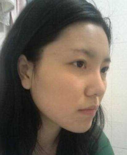 点击右方咨询窗口与觅美网*在线咨询 颧骨降低+下巴矫正手术32天后
