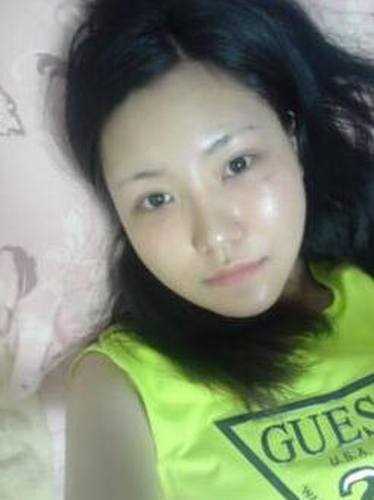 点击右方咨询窗口与觅美网*在线咨询 颧骨降低+下巴矫正手术32天后
