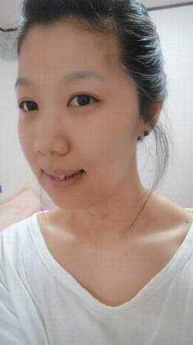 【点击右方咨询窗口与觅美网专业整形*在线交流】 下颚整形+长脸矫正手术9个月后