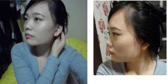【点击右方咨询窗口与觅美网专业整形*在线咨询】 下颌角削骨+磨颧骨手术