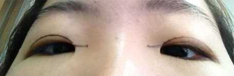 【点击右方咨询窗口与觅美网*设计适合您的项目】 韩式三点双眼皮+开眼角手术后日记