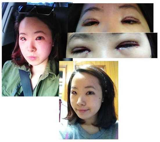 【点击右方咨询窗口与觅美网*设计适合您的项目】 韩式三点双眼皮+开眼角手术后日记