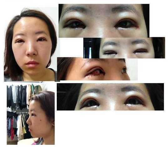 【点击右方咨询窗口与觅美网*设计适合您的项目】 韩式三点双眼皮+开眼角手术后日记