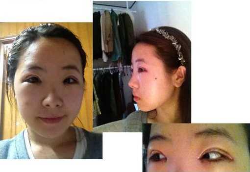 【点击右方咨询窗口与觅美网*设计适合您的项目】 韩式三点双眼皮+开眼角手术后日记