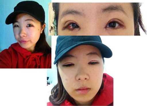 【点击右方咨询窗口与觅美网*设计适合您的项目】 韩式三点双眼皮+开眼角手术后日记