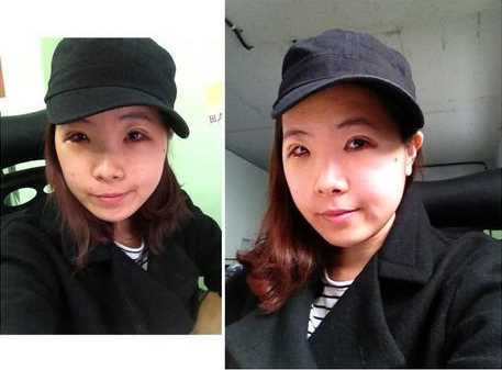 【点击右方咨询窗口与觅美网*设计适合您的项目】 韩式三点双眼皮+开眼角手术后日记