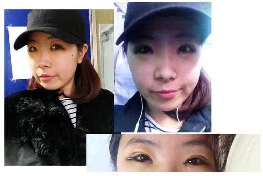 【点击右方咨询窗口与觅美网*设计适合您的项目】 韩式三点双眼皮+开眼角手术后日记