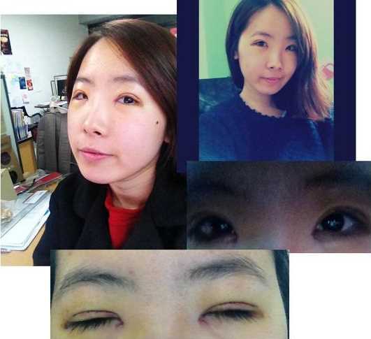 【点击右方咨询窗口与觅美网*设计适合您的项目】 韩式三点双眼皮+开眼角手术后日记