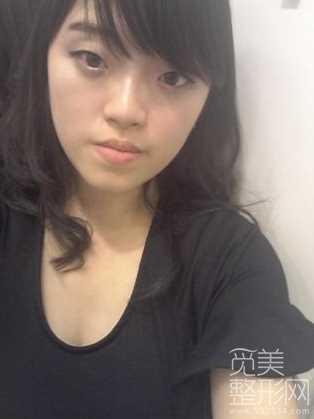 地包天矫正+韩式三点双眼皮+综合隆鼻【觅美网】 地包天矫正+韩式三点双眼皮+综合隆鼻【觅美网】