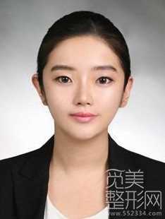 地包天矫正+韩式三点双眼皮+综合隆鼻【觅美网】 地包天矫正+韩式三点双眼皮+综合隆鼻【觅美网】