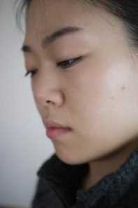 【觅美网专家在线交流-点击右方咨询窗口与专家交流】 硅胶隆鼻+脸部自体脂肪填充整形手术2个月后