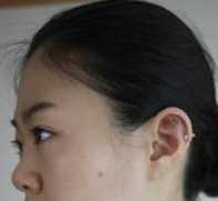【觅美网专家在线交流-点击右方咨询窗口与专家交流】 硅胶隆鼻+脸部自体脂肪填充整形手术2个月后