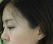 【觅美网专家在线交流-点击右方咨询窗口与专家交流】 硅胶隆鼻+脸部自体脂肪填充整形手术2个月后