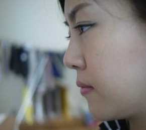 【觅美网专家在线交流-点击右方咨询窗口与专家交流】 硅胶隆鼻+脸部自体脂肪填充整形手术2个月后