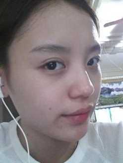 【点击右方咨询窗口觅美网免费为您提供专业的整形咨询】 硅胶隆鼻+自体脂肪填充术后照片
