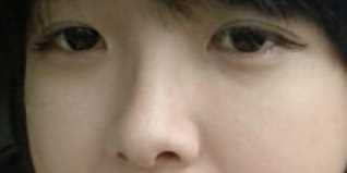 【点击右方咨询窗口觅美网为您预约免费您当地*好的医院医生】 开眼角+硅胶隆鼻+软骨垫鼻尖3个月后
