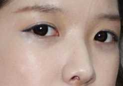 【点击右方咨询窗口觅美网为您预约免费您当地*好的医院医生】 开眼角+硅胶隆鼻+软骨垫鼻尖3个月后