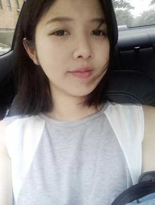 【点击右方咨询窗口觅美网为您预约免费您当地*好的医院医生】 开眼角+硅胶隆鼻+软骨垫鼻尖3个月后