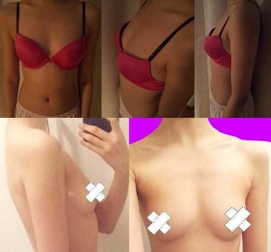 【点击右方咨询窗口觅美网为您免费提供整形咨询】 乳房下垂矫正和假体隆胸手术