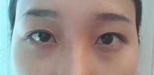 【点击页面上的咨询窗口觅美网专家在线为您免费设计适合您的手术方案】 觅美网 开眼角 自体脂肪填充全脸 眼部修复
