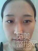 【点击页面上的咨询窗口觅美网专家在线为您免费设计适合您的手术方案】 觅美网 开眼角 自体脂肪填充全脸 眼部修复