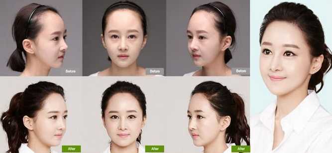 发际线多少钱?*果好吗?