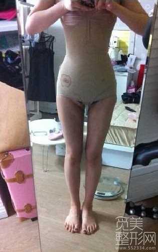 手臂吸脂 腹部吸脂 大腿吸脂案例图 手臂吸脂 腹部吸脂 大腿吸脂案例图