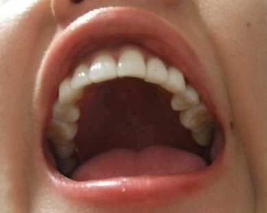 牙齿矫正手术案例图分享
