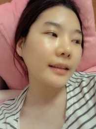 【点击页面上的咨询窗口与觅美网专业整形*在线交流】 颧骨降低手术+下颌角手术