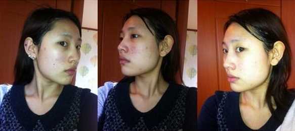 【点击页面上咨询窗口与觅美网专业整形*在线交流】 西京医院做的下颌角削骨手术*果图