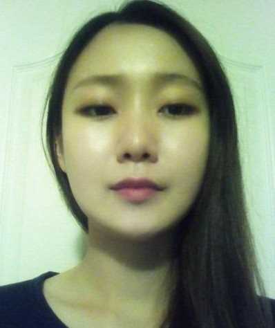 【点击咨询窗口获取更多整形案例以及讲解】 下颌角削骨和颧骨降低手术