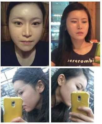 颧骨降低 自体脂肪填充法令纹 鼻部修复 颧骨降低 自体脂肪填充法令纹 鼻部修复