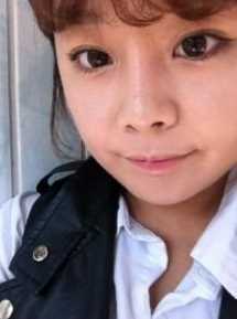 【点击页面咨询窗口与*在线交流】 双眼皮+硅胶隆鼻整形手术7个月后