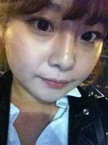 【点击页面咨询窗口与*在线交流】 双眼皮+硅胶隆鼻整形手术7个月后