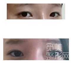 【点击页面上咨询窗口获取更多整形案例】 全切双眼皮修复和矫正鹰钩鼻手术2周后