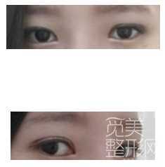 【点击页面上咨询窗口获取更多整形案例】 全切双眼皮修复和矫正鹰钩鼻手术2周后